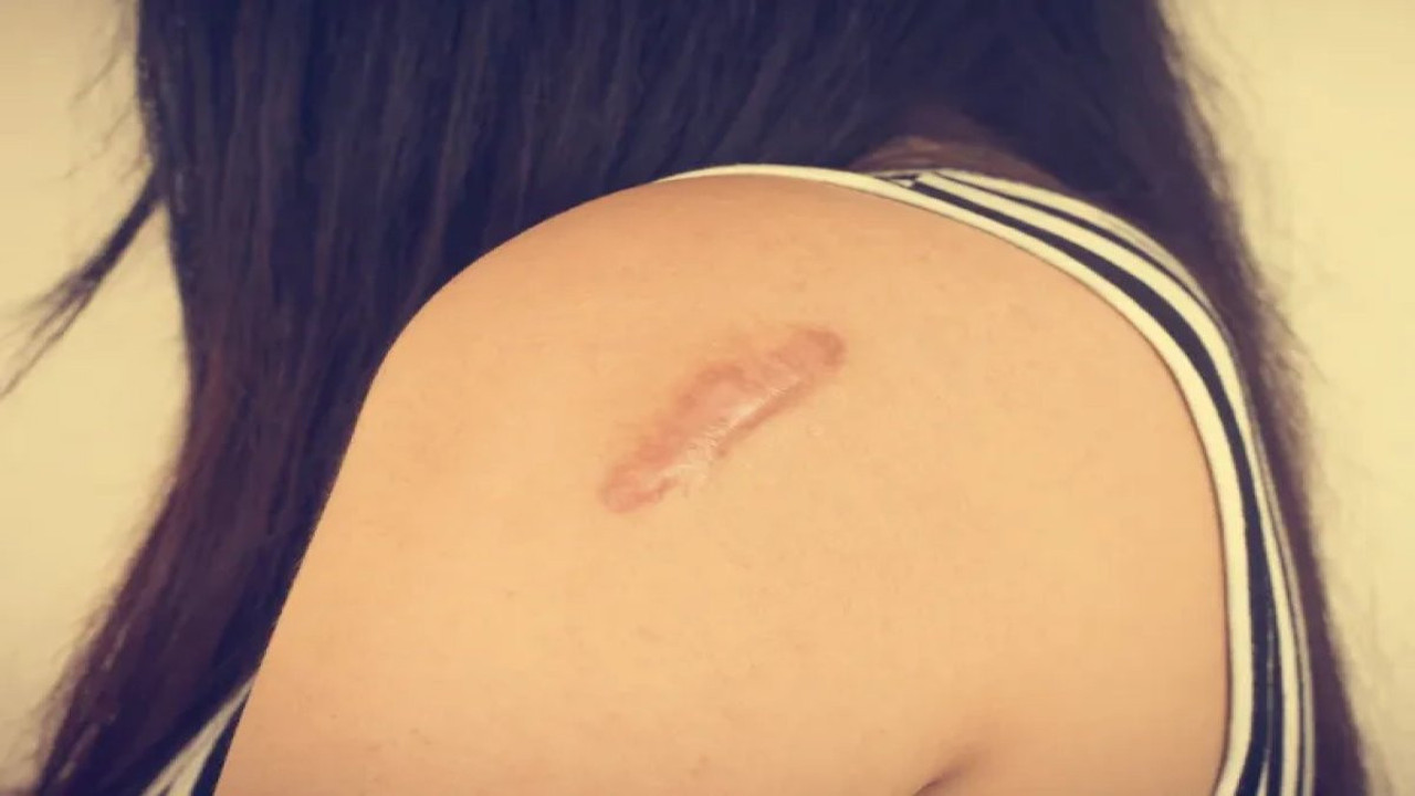 Kalıcı yara izlerine veda ettirecek formülleri uzmanlar anlattı