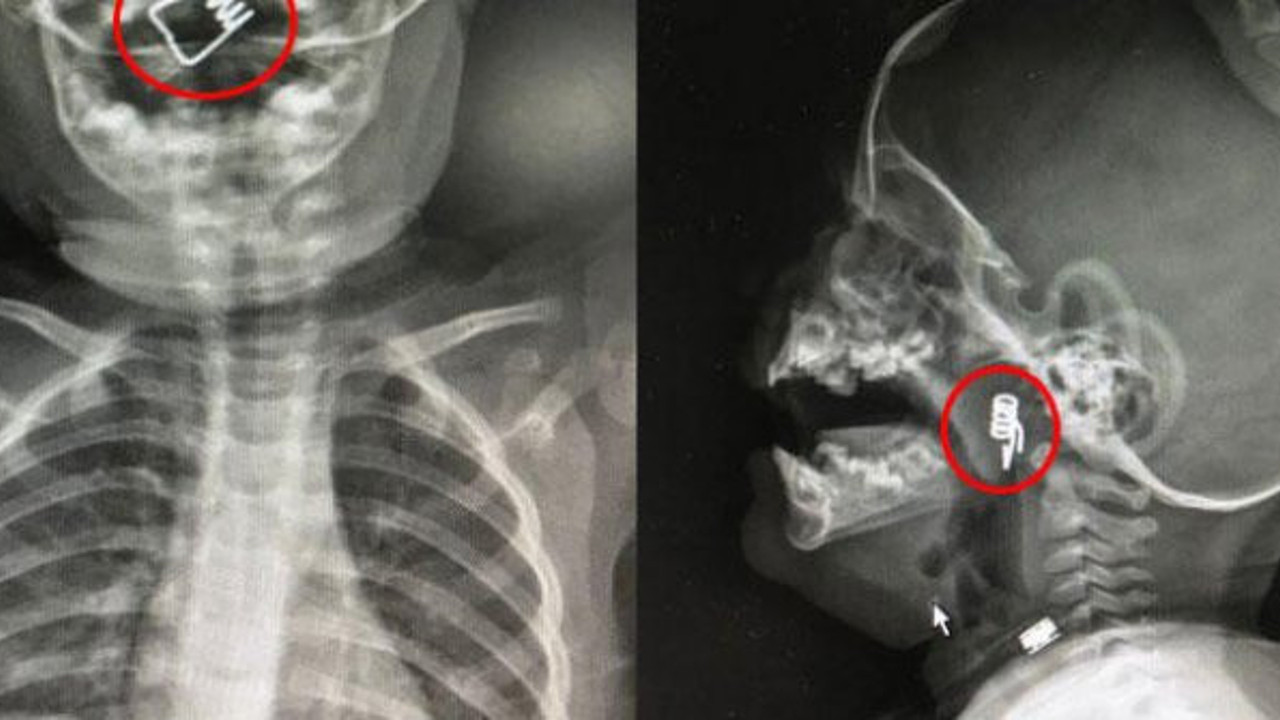 1 yaşındaki bebeğin boğazında tespit edildi