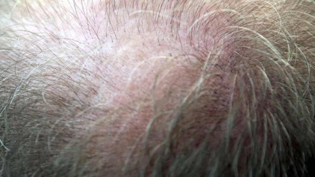 Üç aydan uzun süren saç dökülmelerine dikkat!