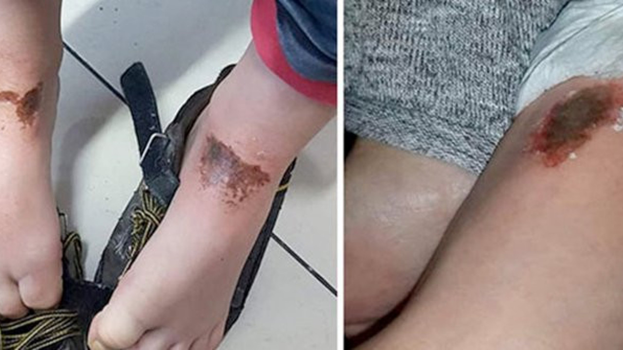 Kar topu oynayan çocukların vücudunda oluşan yanıkların sebebi belli oldu