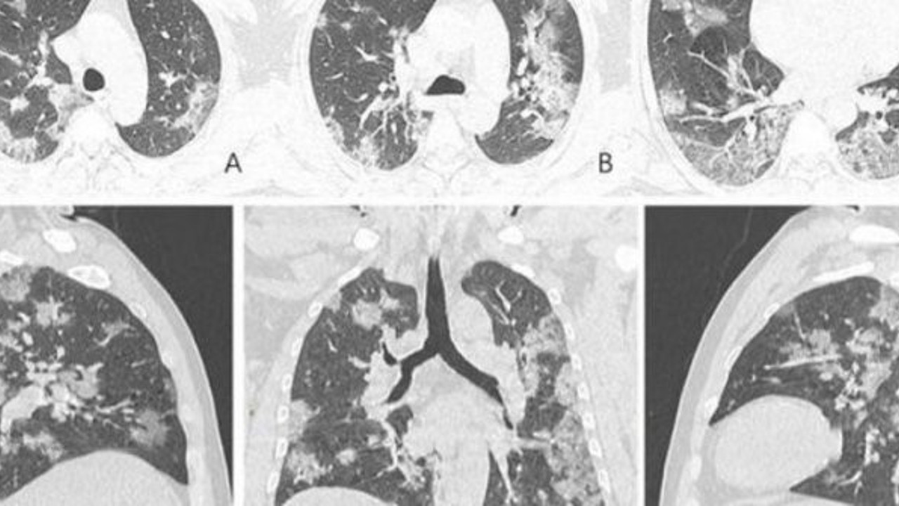 Corona virüsün insan vücudundaki etkisi böyle görüntülendi!