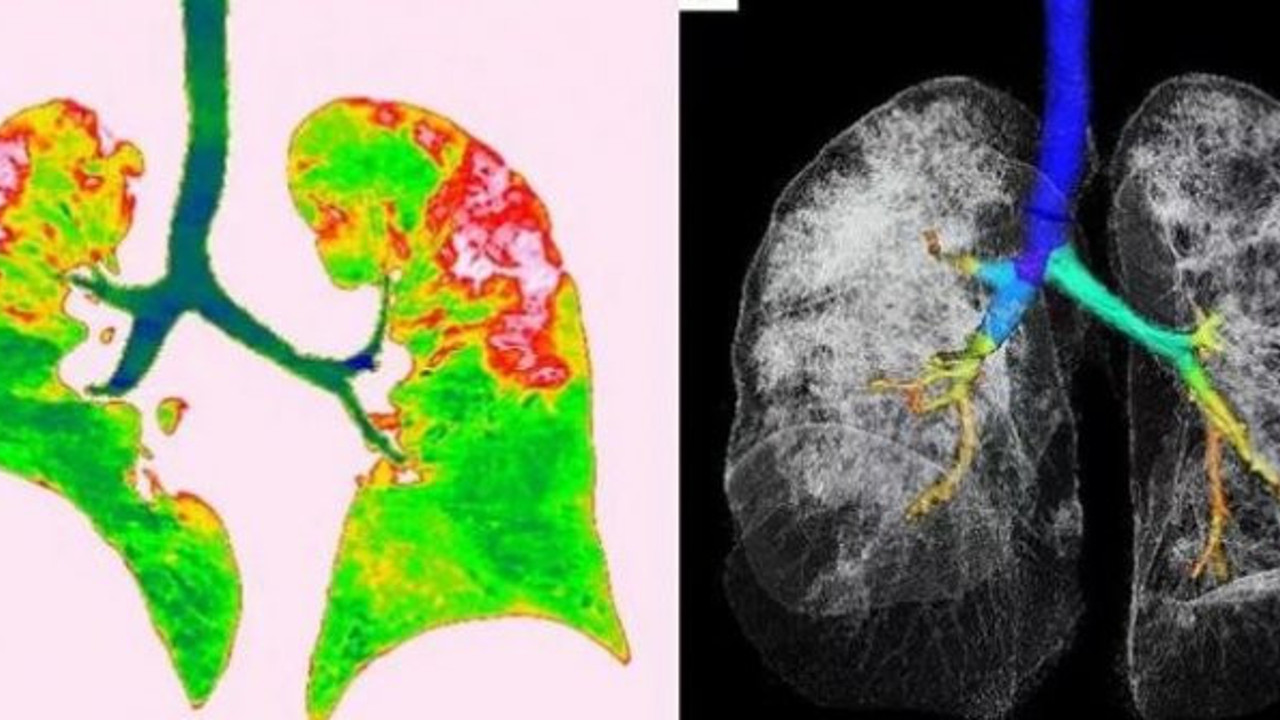 Koronavirüsün akciğere verdiği zarar görüntülendi!
