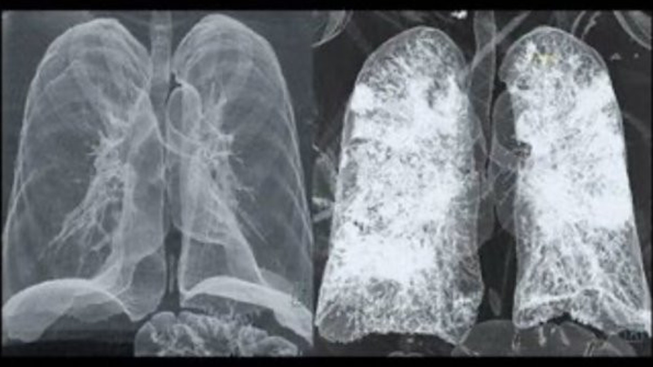 Korona ciğerleri bu hale getiriyor: Siz hâlâ dışarıda gezin