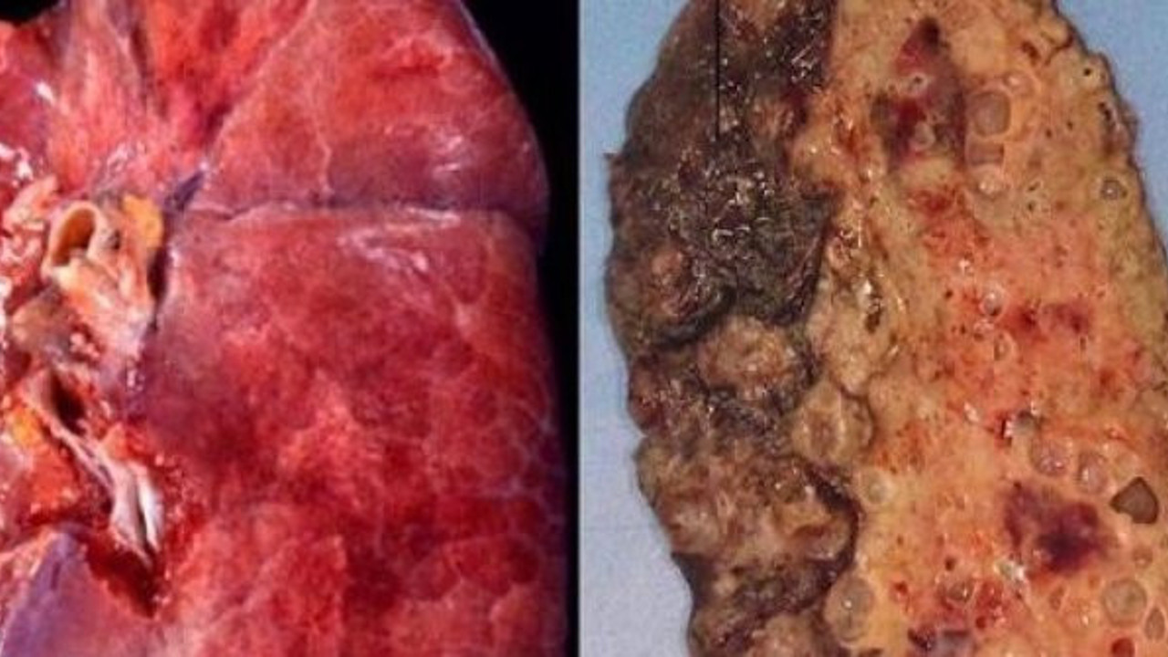 Korona virüsün akciğerlere verdiği hasar ilk defa bu kadar net görüntülendi