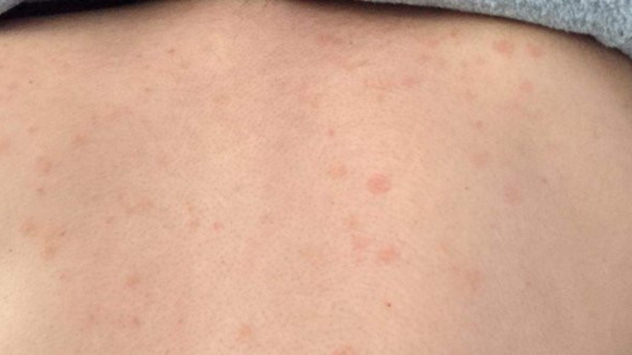 Korona virüs hastalarında önemli çalışma: 210 hastada görüldü