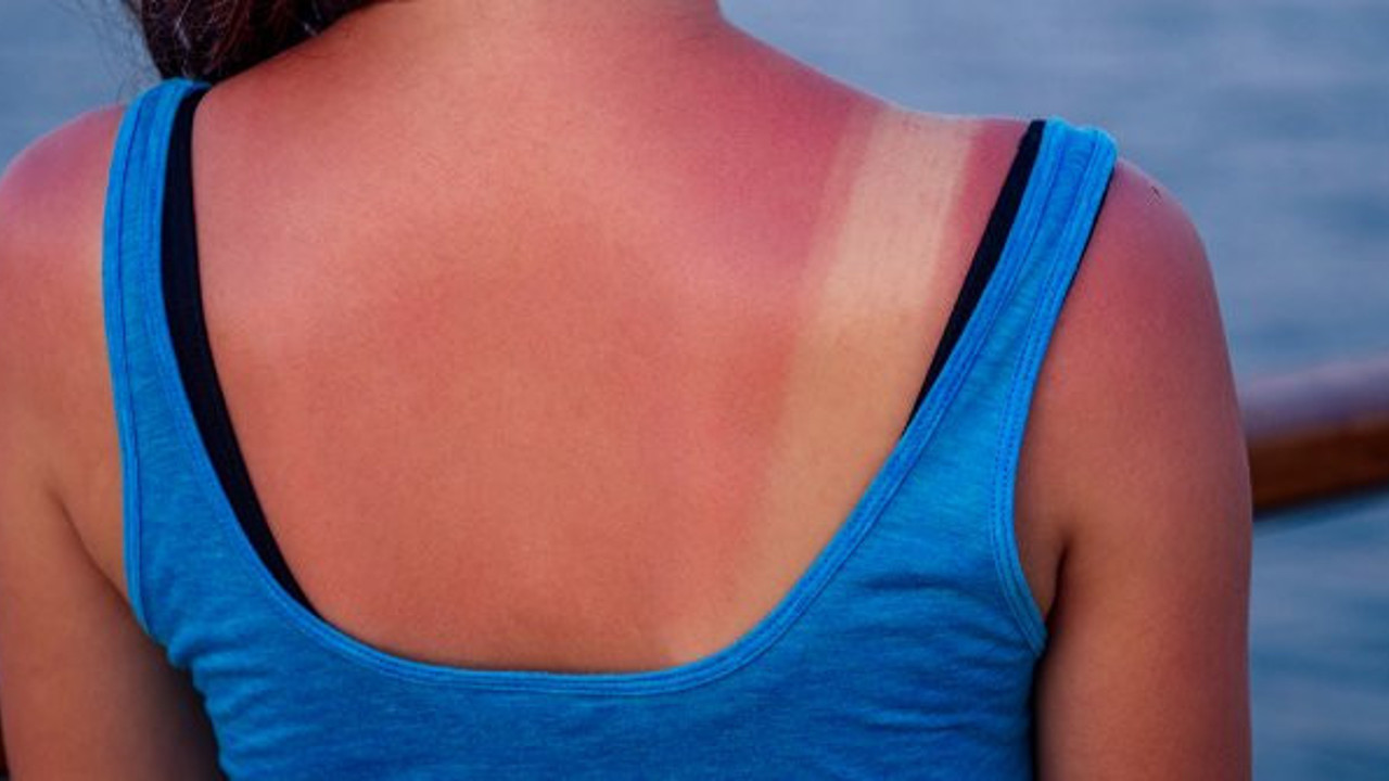 Yıllarca yanlış yapmışız: Güneş yanığına bunları asla sürmeyin