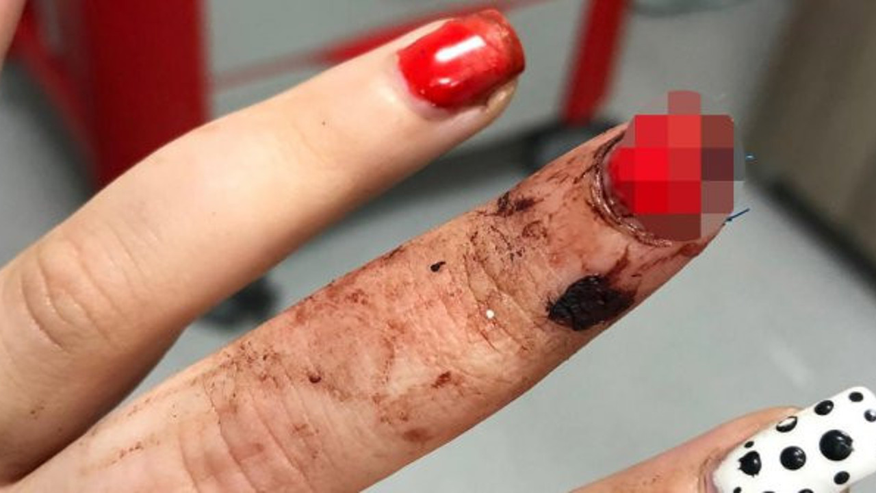 Gittiği köftecide parmağı koptu! Hayatının şokunu yaşadı