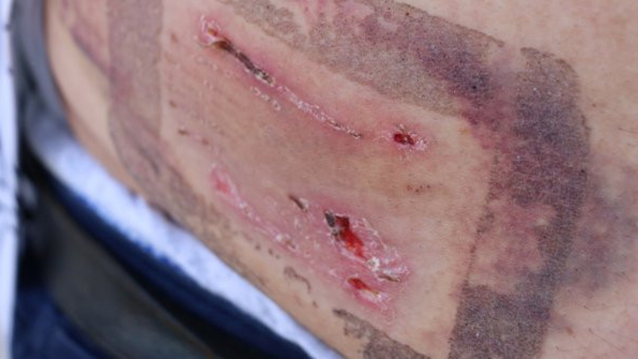 Azgın 2 Pitbull'la 10 dakika boğuştu! 100 iğne yedi, 40 dikiş atıldı