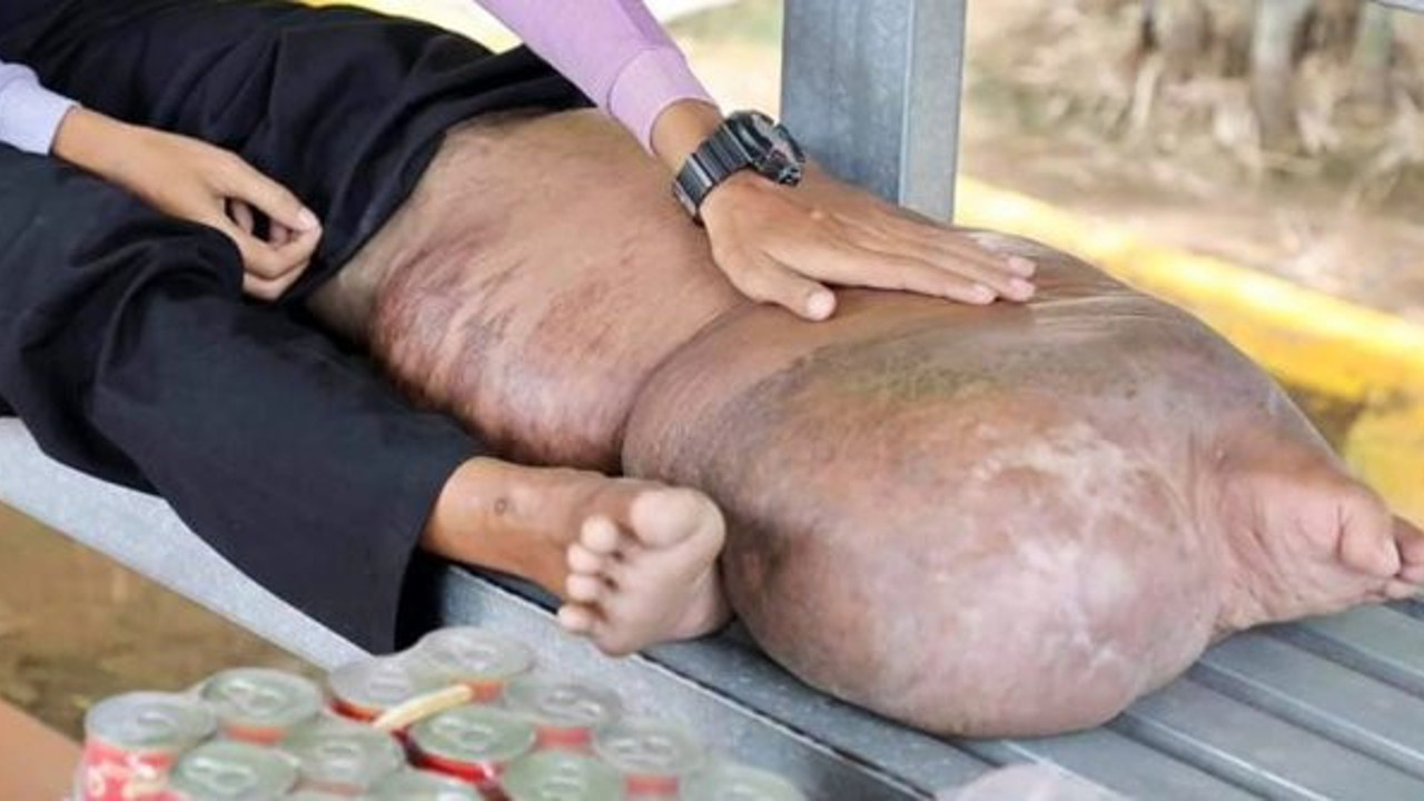 Sivrisinek ısırığı ayağını davul gibi yaptı. Türkiye'de de Asya Kaplan Sivrisineği'ne savaş açıldı