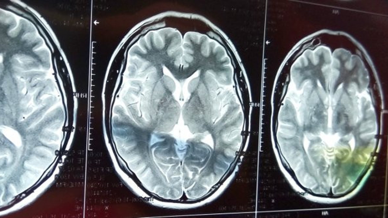 Koronanın uzun süreli bir etkisi daha ortaya çıktı. Yakalananlar kolay kolay atlatamıyor