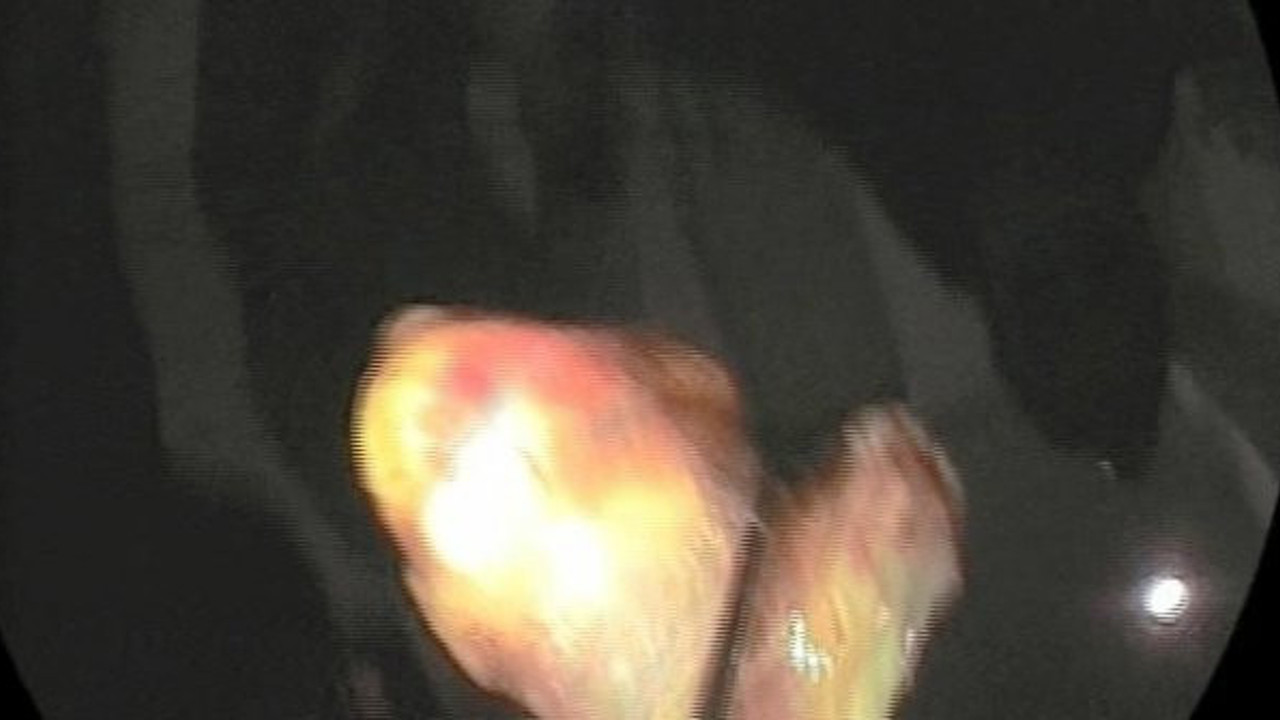 Korona virüsten şüphelendi. Akciğerinden çıkana kendisi bile şaşırdı