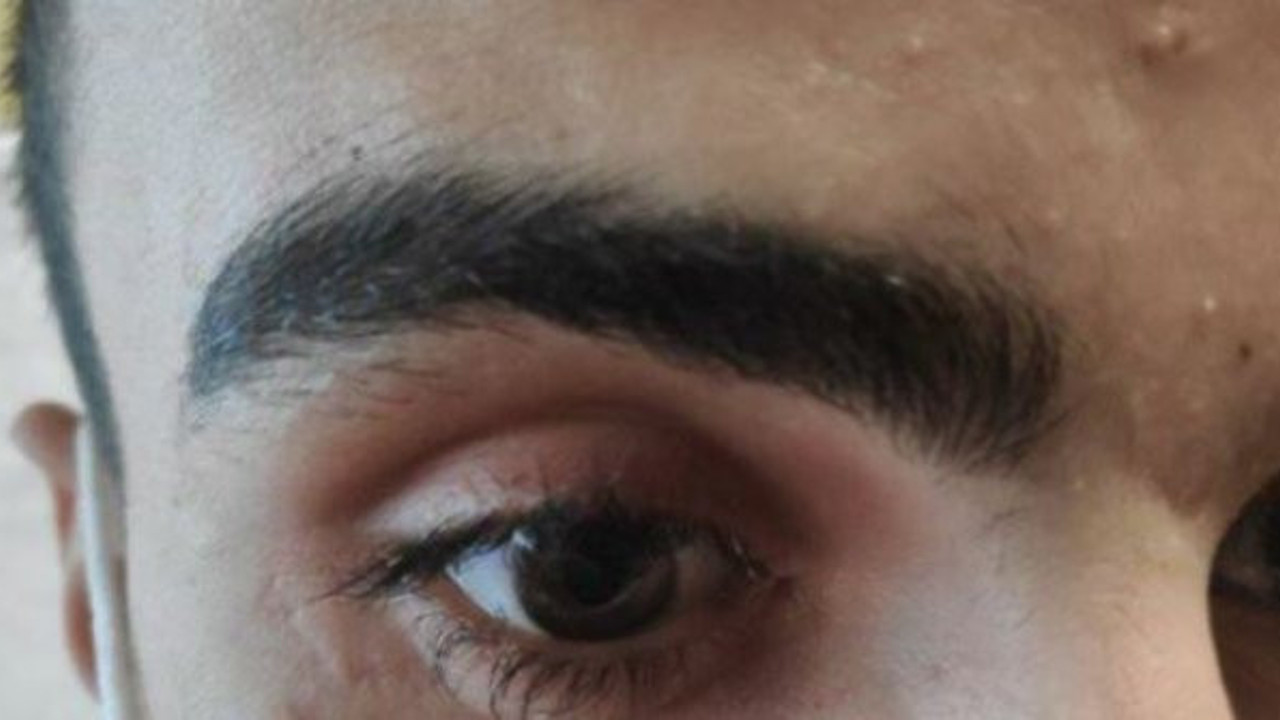 Ameliyat sırasında unutulanlara bir yenisi daha eklendi. Gözünde bir ay boyunca bununla yaşadı