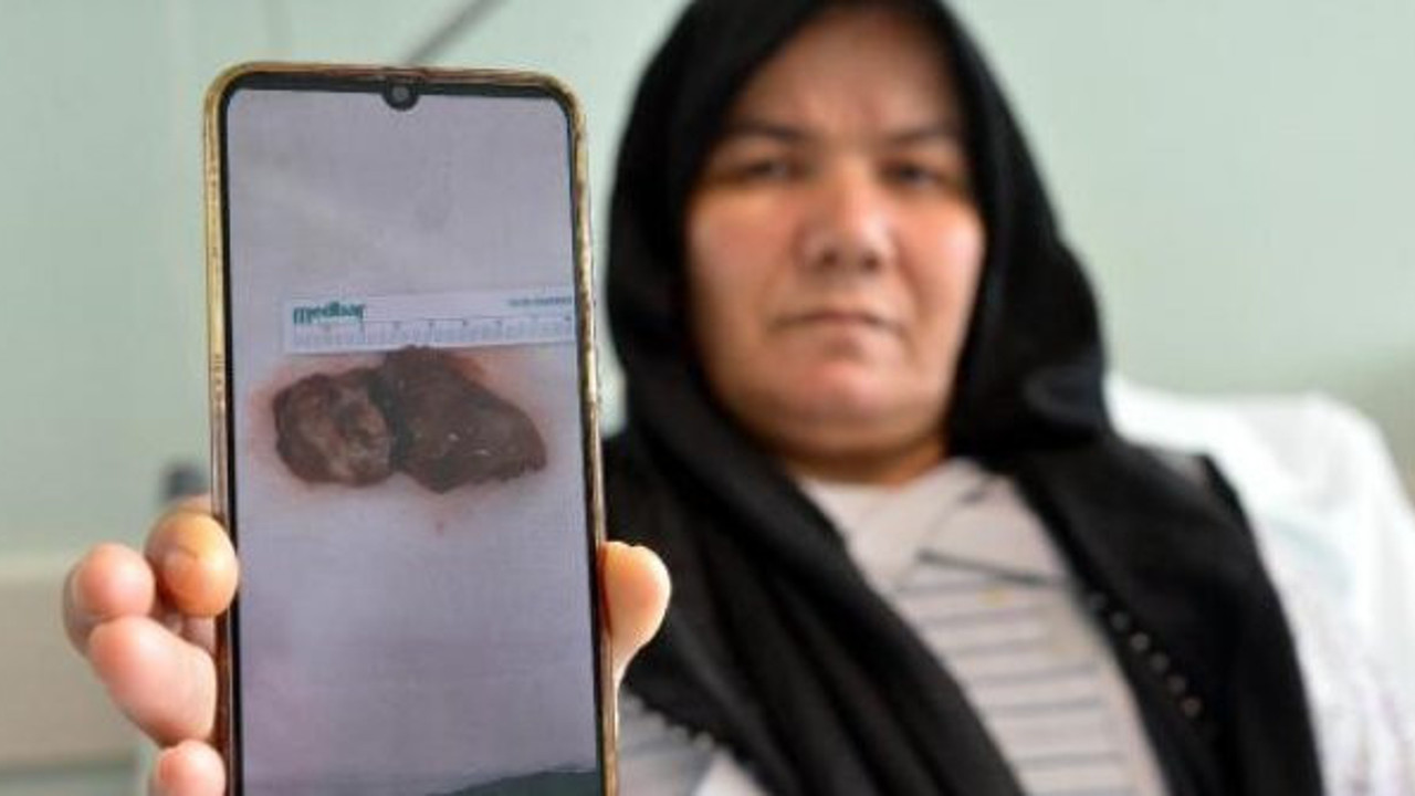 Ameliyatta kalbi 2 saat durduruldu. Doktorlar bile çıkan şeye şaşırdı