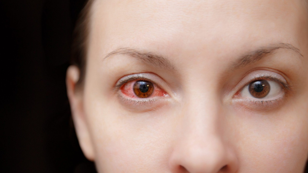 Prof. Dr. Onur Yaprak ‘gözlerinizde bu varsa dikkat’ dedi: Hızlı şekilde doktora başvurun