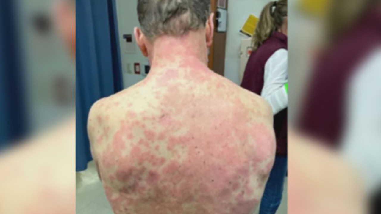 Johnson ve Johnson aşısında beklenmeyen yan etki. Dört gün sonra vücudunun her yerini sardı