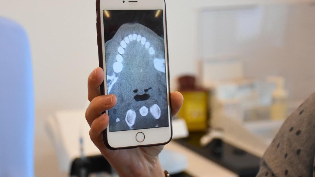 İzmir'de kokoreç yerken diline takıldı. Doktorlar bile şaşırtıcı buldu