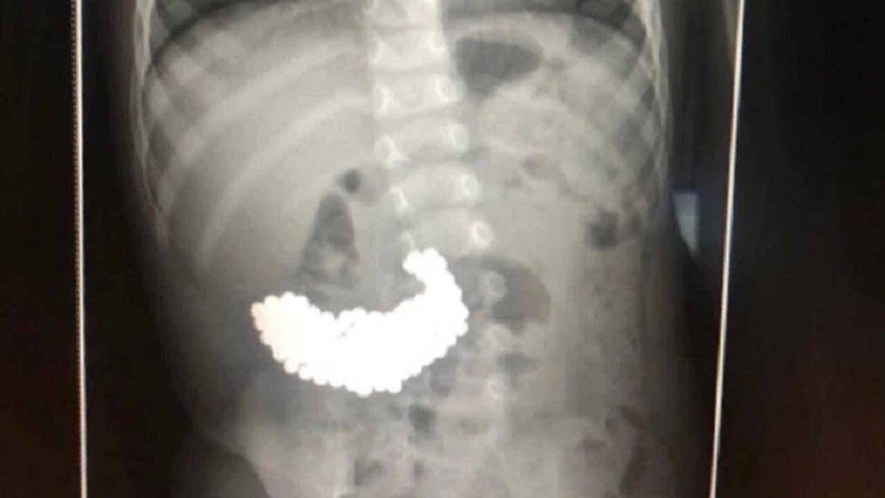 2 yaşındaki çocuğun midesinden çıktı. Görenler hayrete düştü