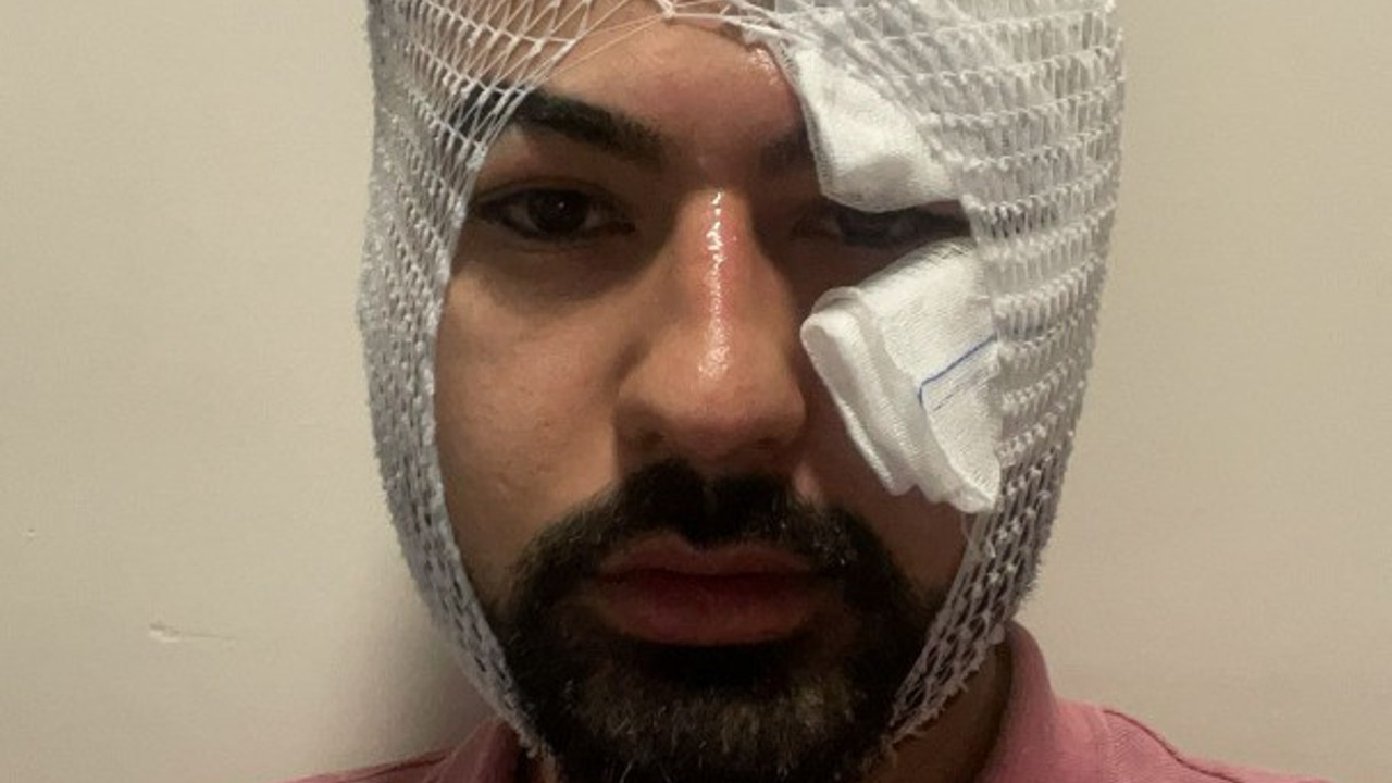 Fildişi macunu deneyi yaparken yüzünü yaktı