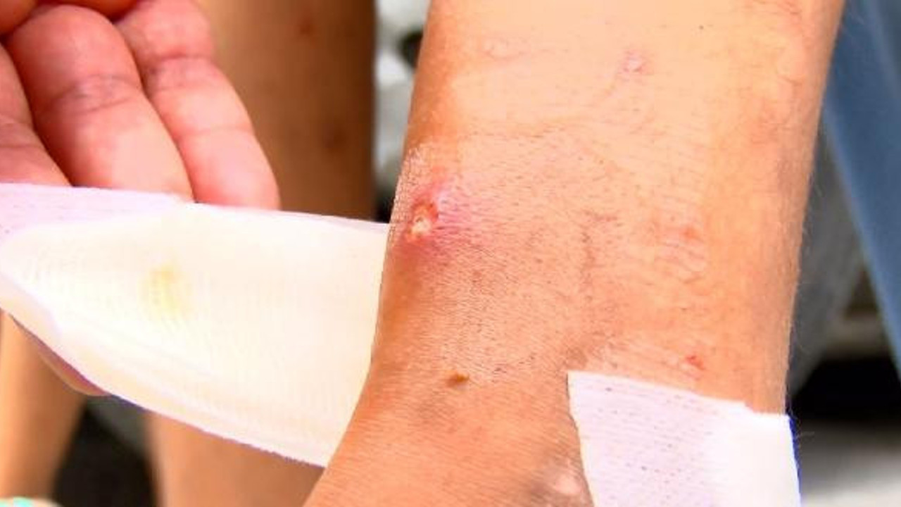 İstanbul'da büyük tehlike. Anında saldırıyor vücutta cılk yaralar oluşuyor