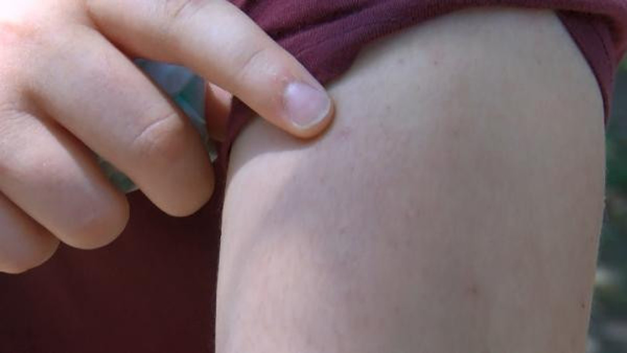 İstanbul’da kabus büyüyor. Çocukların vücutlarında yaralar ortaya çıktı