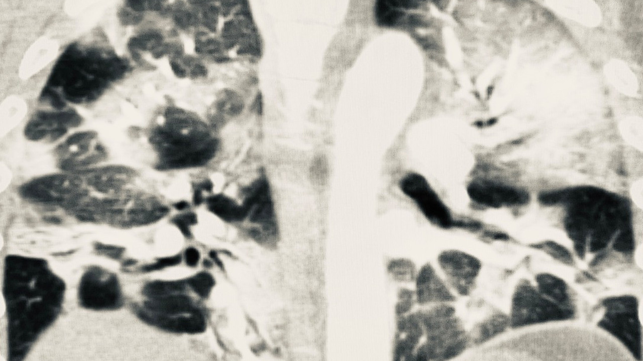 Aşı olanlarda korona virüs akciğere zarar vermiyor! İşte 2 kişiye ait tomografi sonuçları