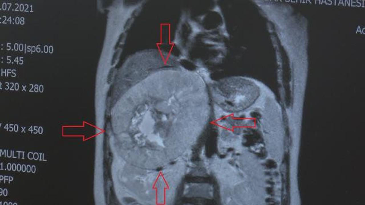 Karnından çıkanı gören doktorlar gözlerine inanamadı