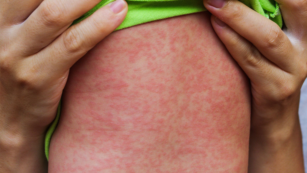 22 milyondan fazla çocuk kızamık aşısı olamadı