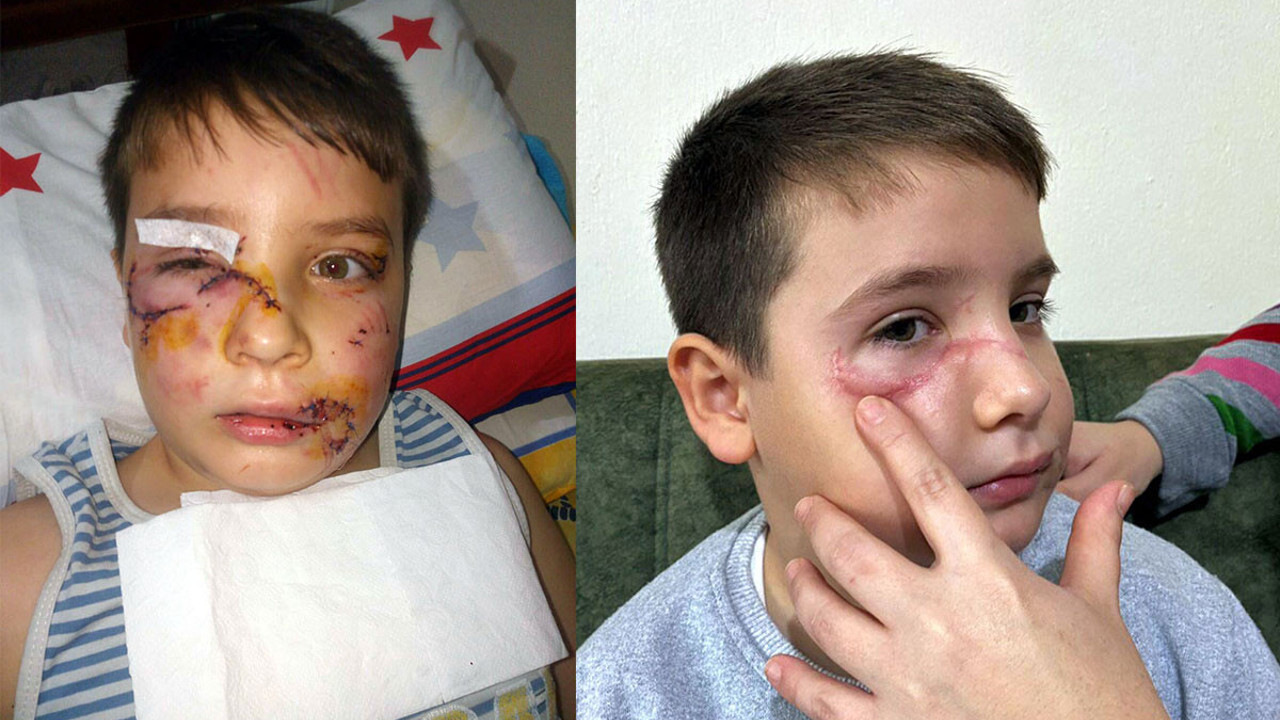 Köpekler saldırdığı için yüzüne 60 dikiş atılmıştı. Zavallı çocuk 36 gün sonra ilk defa dışarı çıkabildi