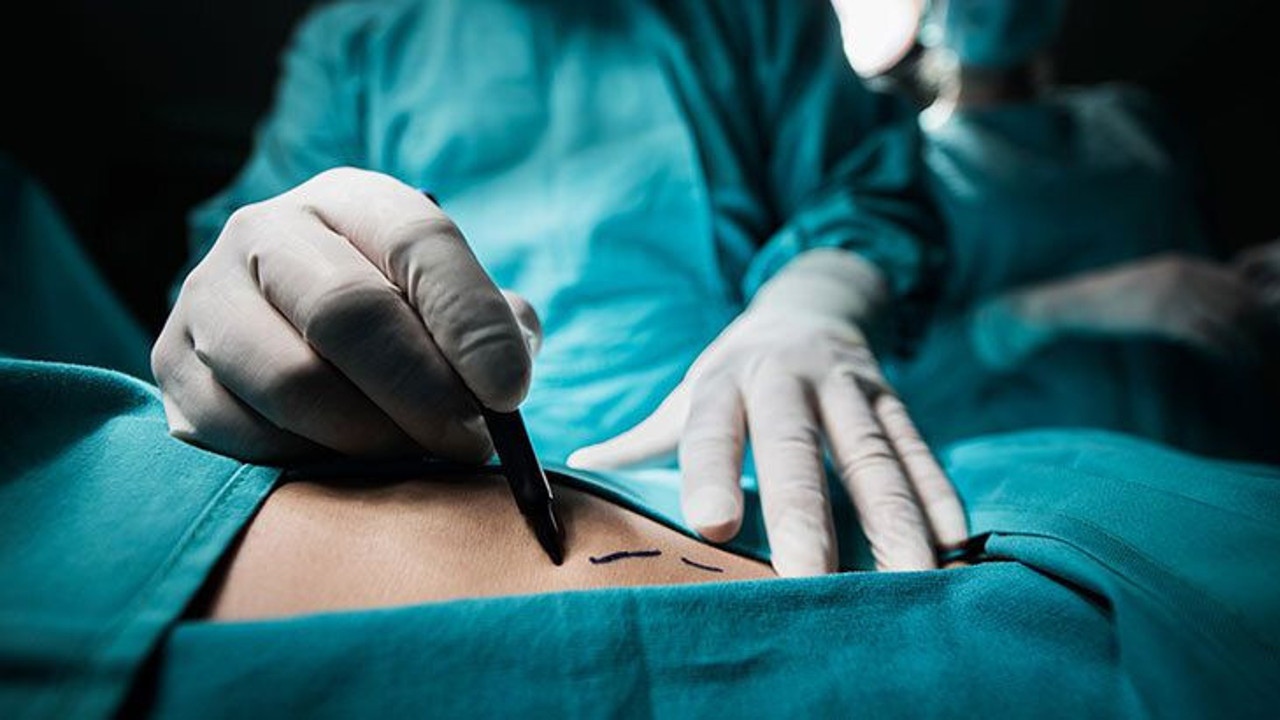 Liposuction hakkında merak edilenler