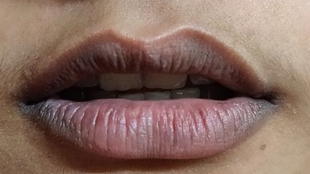 Dudaklarınızda morluk varsa, korona testi yaptırın