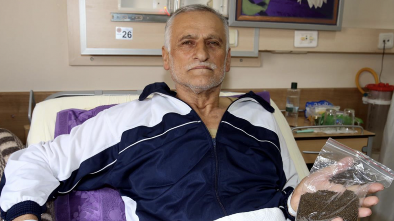 Safra kesesinden binlerce taş çıkarıldı: Guinness'e başvuracak