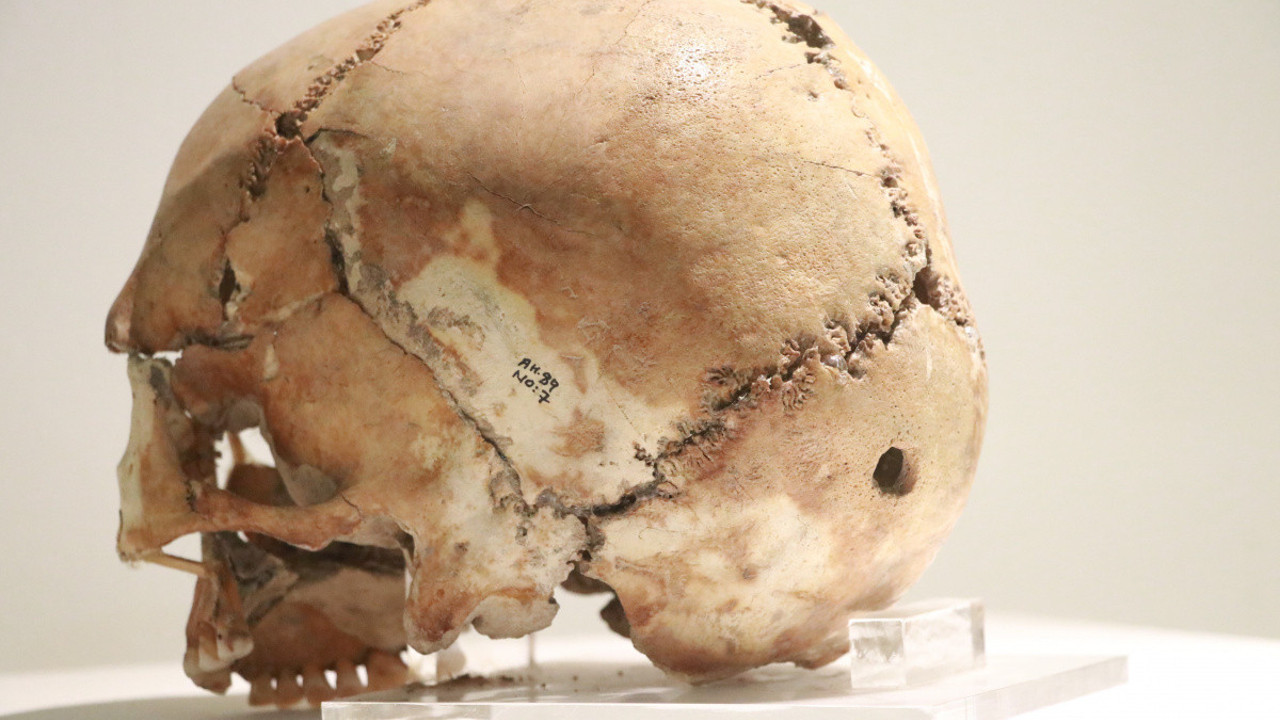 Dünyanın ilk beyin ameliyatı Türkiye'de yapıldı