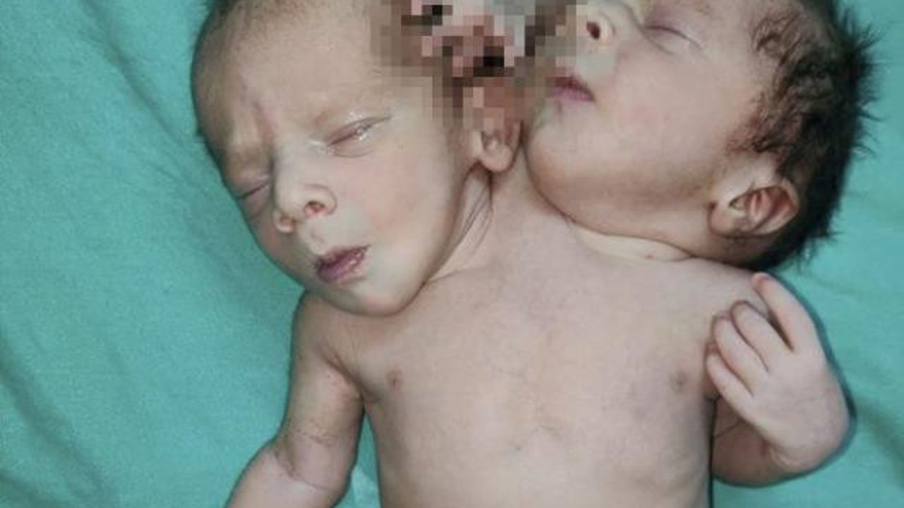 Çift başlı bebeği görenin ağzı açık kaldı