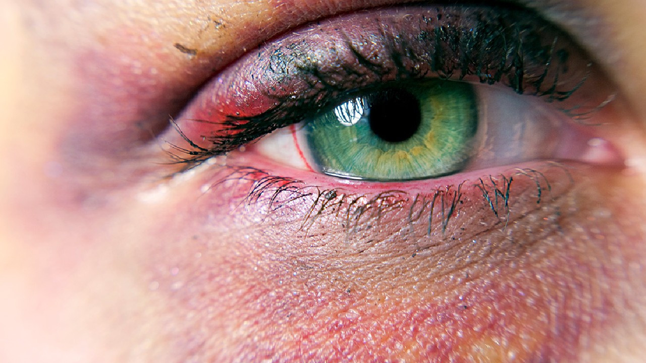 Vücuda sert bir cisim vurunca neden morluk oluşur?