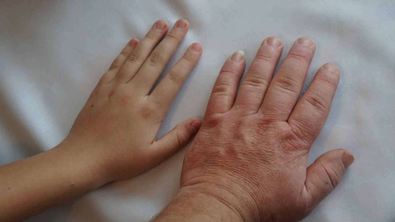 Bu hastalıkta erken tanı yaşam süresini uzatıyor