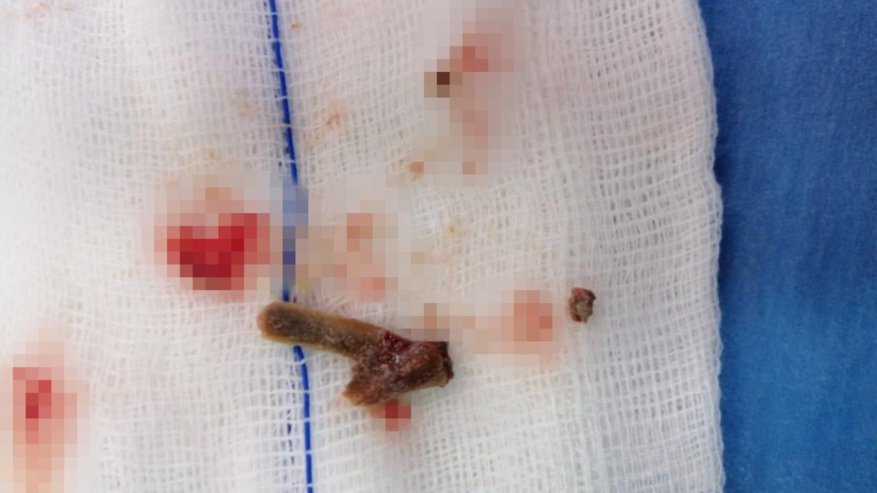 Öksürük şikayetiyle hastaneye gitti, 5 yıldır akciğerinde lades kemiğiyle yaşadığını öğrendi