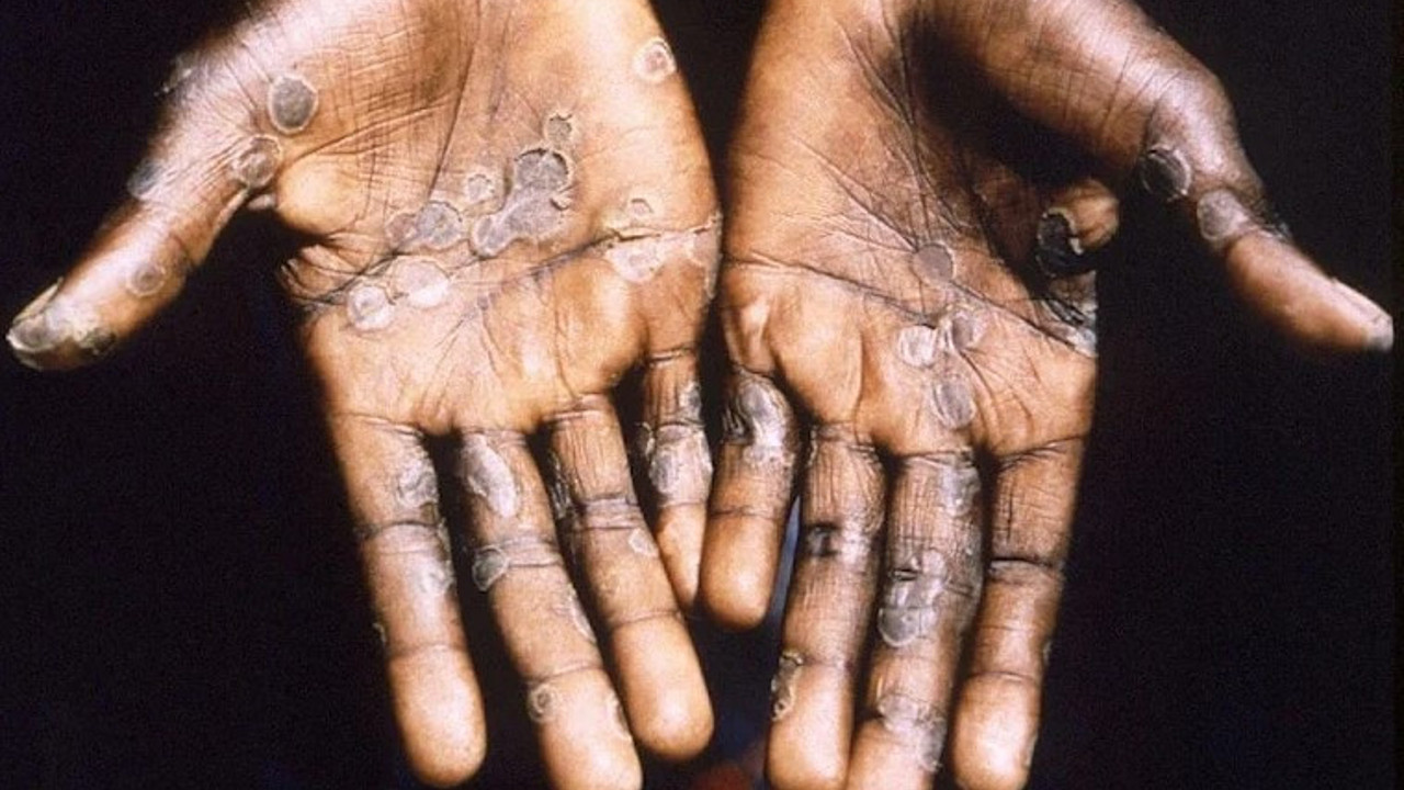 Gitgide yayılıyor: Maymun çiçeği virüsü vakası bir ülkede daha görüldü