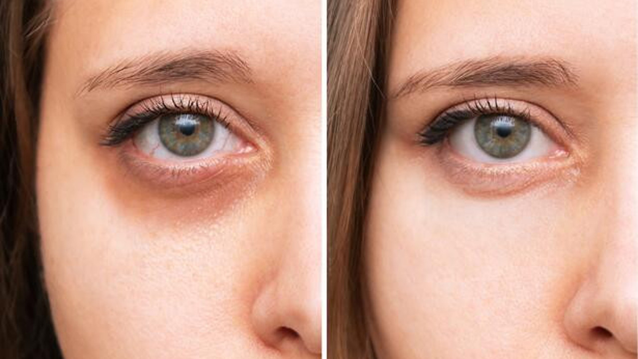 Dr. Hande Ulusal: Gözaltındaki mor halkalar basit bir cilt problemi olmayabilir