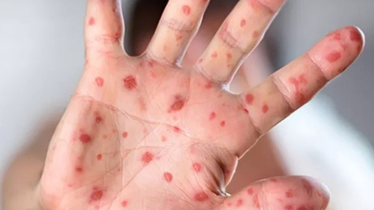 Dünyanın yeni belası o hastalıkla ilgili Türk biliminsanlarından açıklama geldi