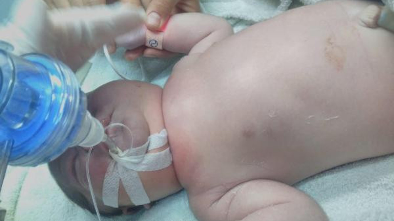 Doğumda köprücük kemiği kırılan bebek entübe edildi! Aile hastane ve doktor hakkında suç duyurusunda bulundu