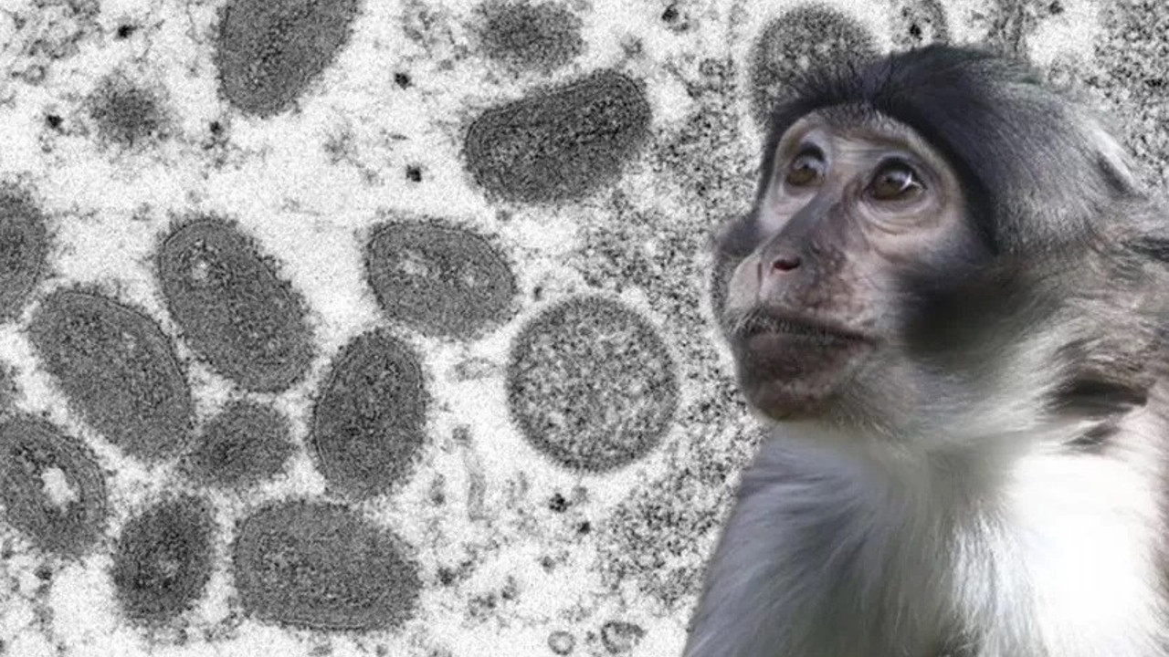 O ülkede maymun çiçeği vakalarında korkutan artış