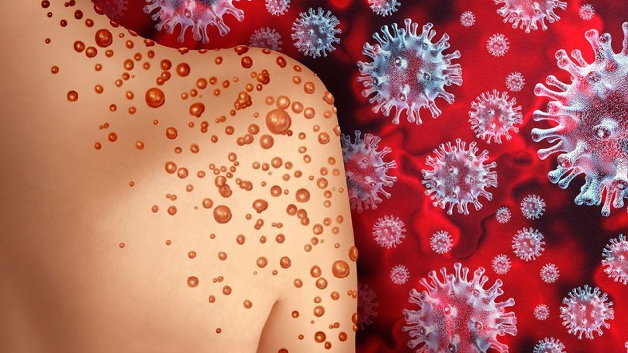 Maymun çiçeği virüsüne vahşi hayvan çözümü