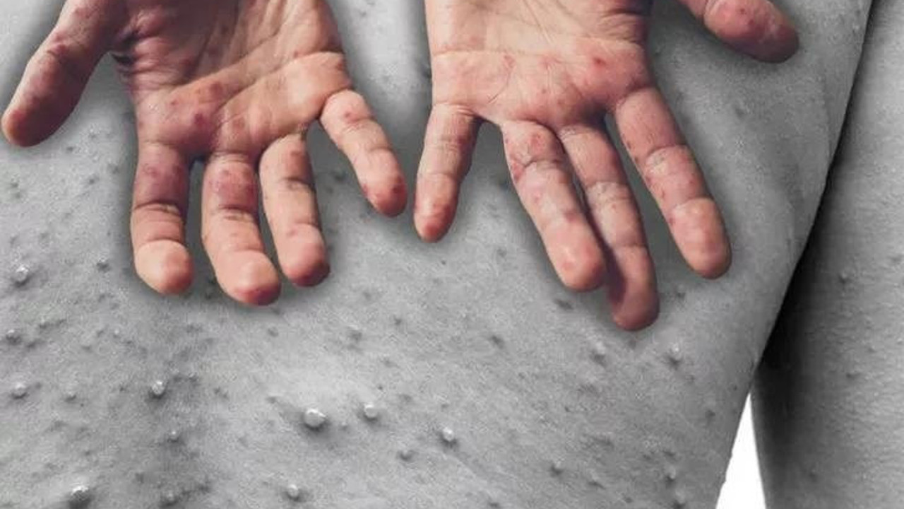 En fazla maymun çiçeği vakasının olduğu yer belli oldu