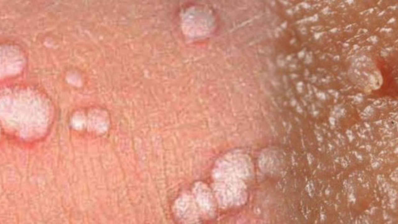 Uzmanı açıkladı: HPV virüsüne dikkat!