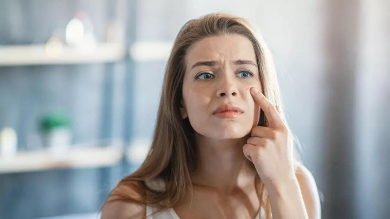 Uzmanı açıkladı. Sivilce karaciğerden mi kaynaklanır?