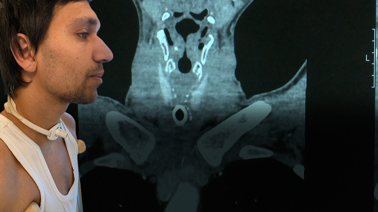 Geçirdiği kaza sonrası nefes borusu tamamen tıkanan genç mucize ameliyat ile sesine kavuştu