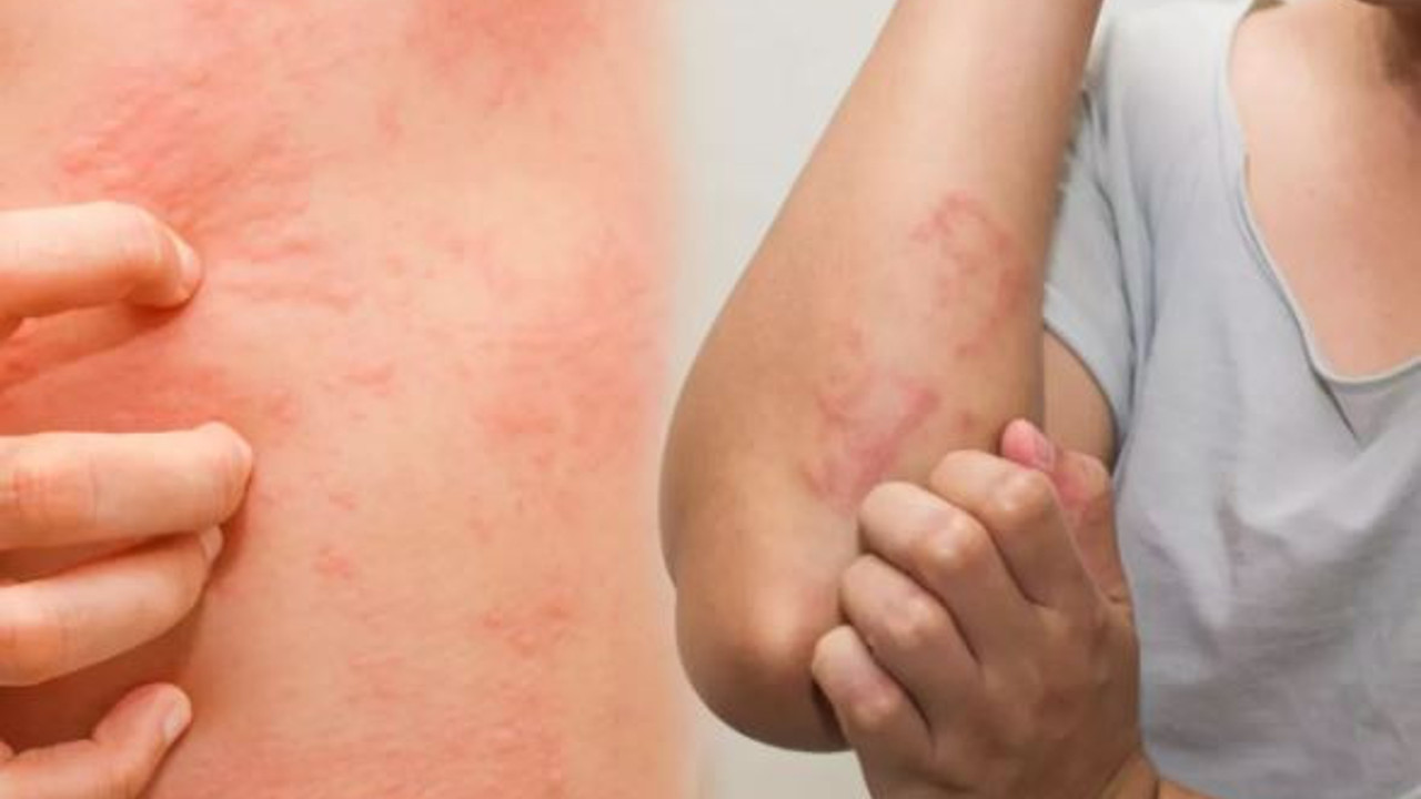 Bunları uygulayın. Korkulu rüyanız haline gelen hastalık bitsin