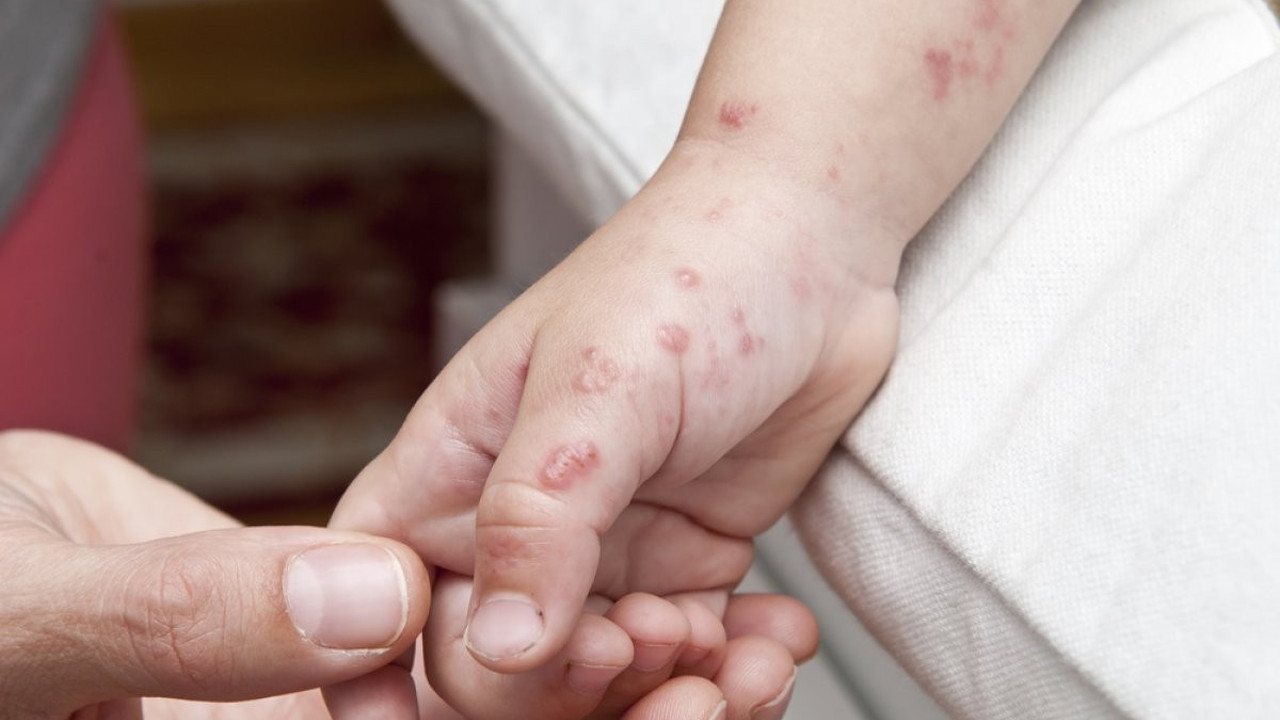 Türkiye'de ilk Maymun Çiçeği görüldü uzmanı uyardı