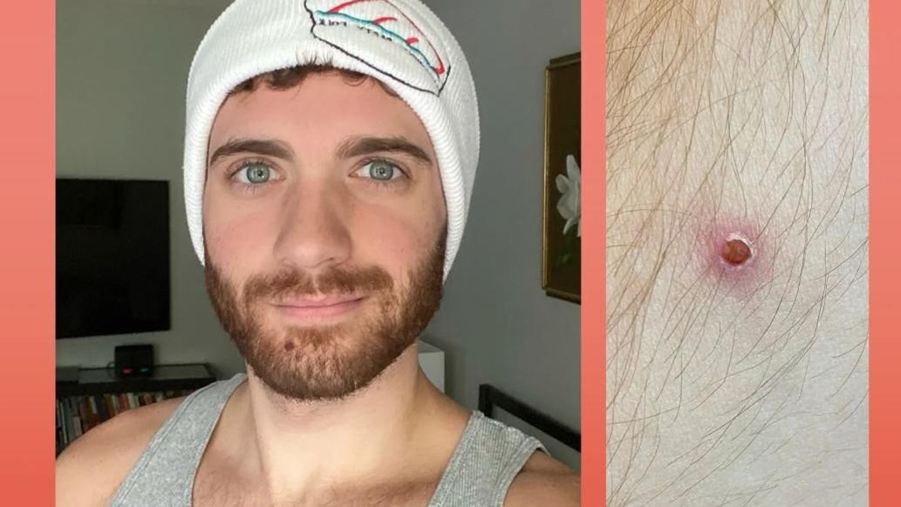 Maymun çiçeğine yakalanan hasta kâbusu anlattı