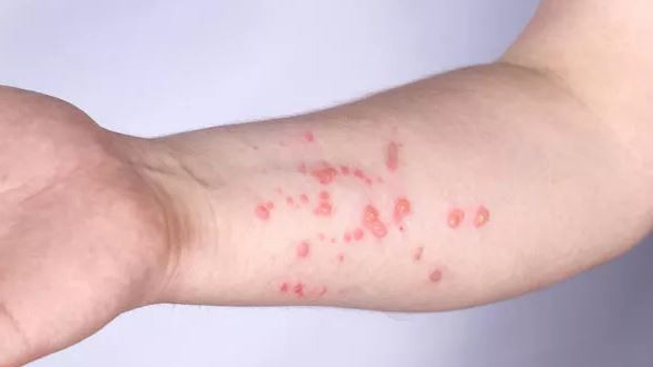 Maymun çiçeği virüsü hakkında merak edilenleri uzmanlar yanıtladı